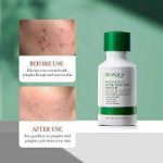 سرم ضد جوش و آکنه سالیسیلیک اسید بیوآکوا BIOAQUA SALICYLIC ACID ACNE REMOVAL ا BIOAQUA